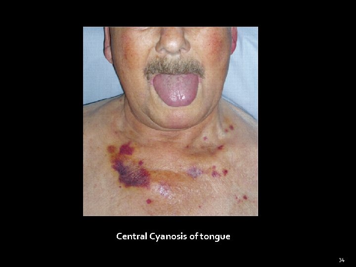 Central Cyanosis of tongue 34 