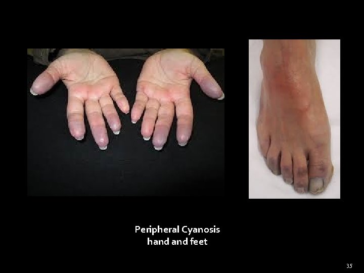 Peripheral Cyanosis hand feet 35 