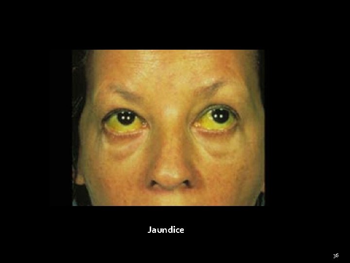 Jaundice 36 