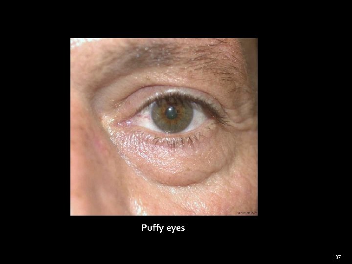 Puffy eyes 37 