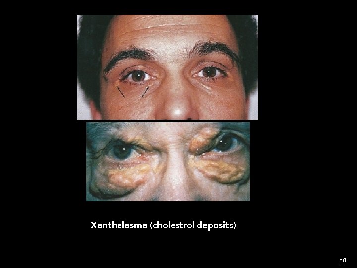 Xanthelasma (cholestrol deposits) 38 