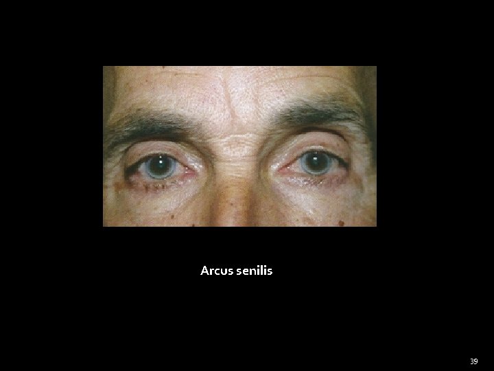 Arcus senilis 39 
