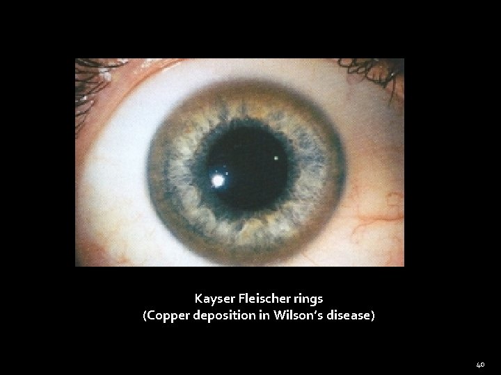 Kayser Fleischer rings (Copper deposition in Wilson’s disease) 40 