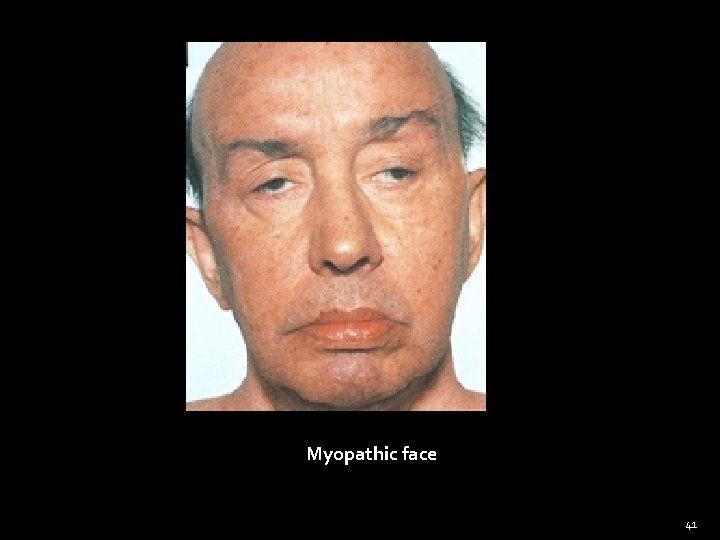 Myopathic face 41 