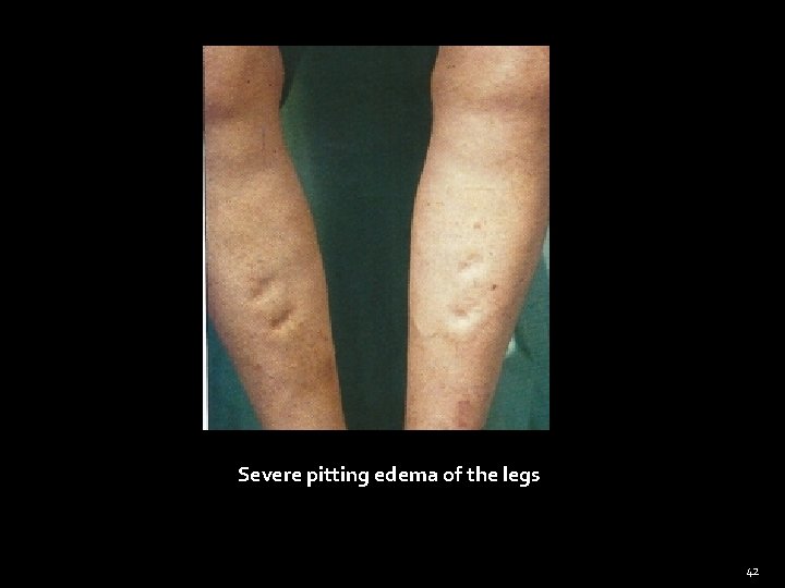 Severe pitting edema of the legs 42 