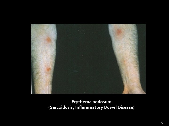 Erythema nodosum (Sarcoidosis, Inflammatory Bowel Disease) 43 