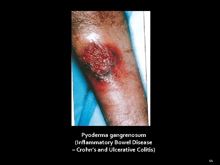 Pyoderma gangrenosum (Inflammatory Bowel Disease – Crohn’s and Ulcerative Colitis) 44 