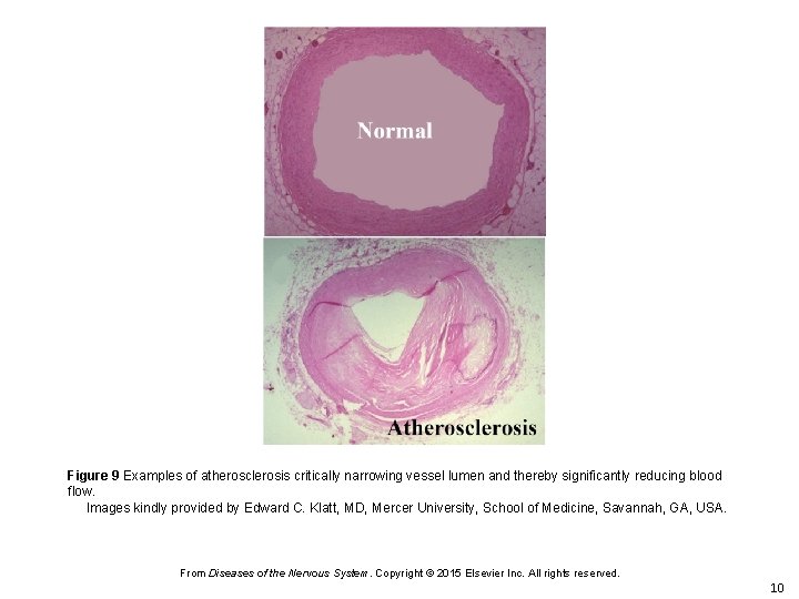 Figure 9 Examples of atherosclerosis critically narrowing vessel lumen and thereby significantly reducing blood