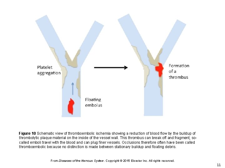 Figure 10 Schematic view of thromboembolic ischemia showing a reduction of blood flow by