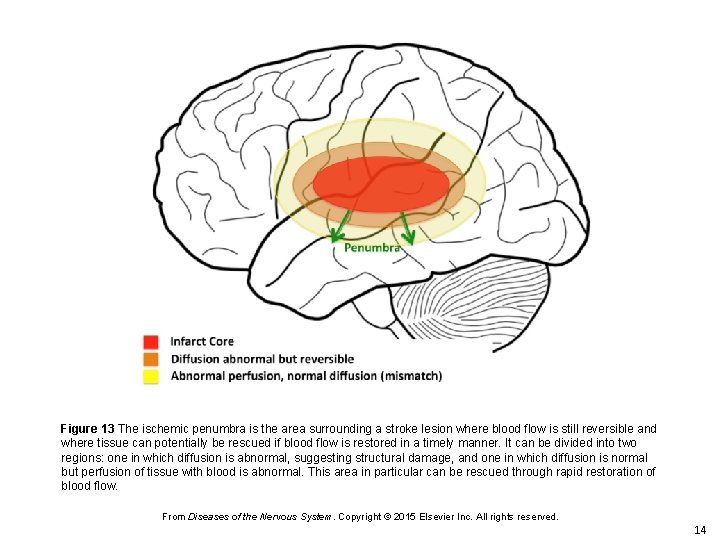 Figure 13 The ischemic penumbra is the area surrounding a stroke lesion where blood