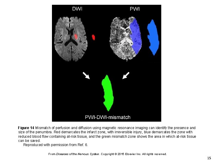 Figure 14 Mismatch of perfusion and diffusion using magnetic resonance imaging can identify the