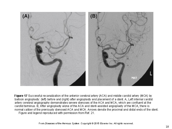 Figure 17 Successful recanalization of the anterior cerebral artery (ACA) and middle carotid artery