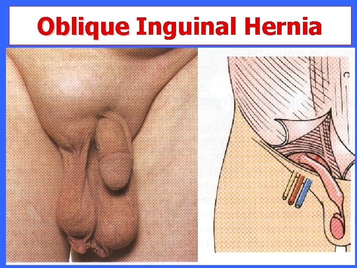 Oblique Inguinal Hernia 
