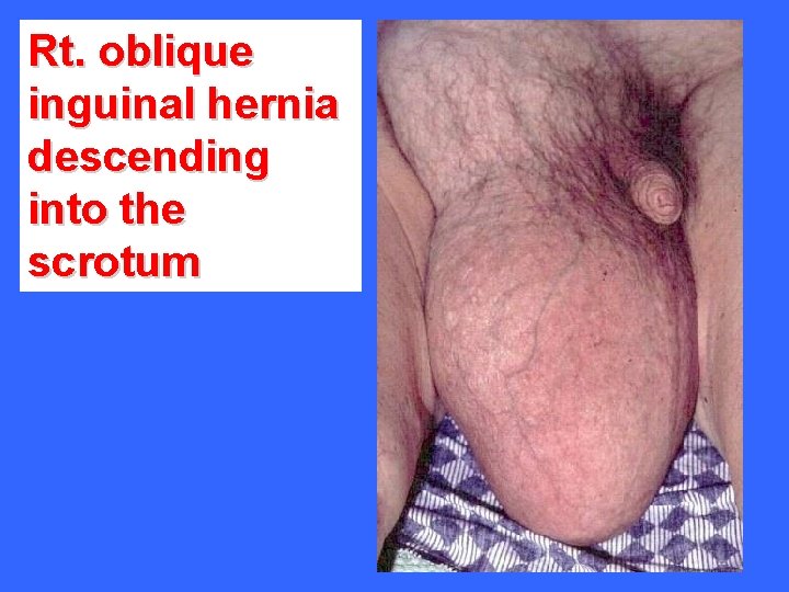 Rt. oblique inguinal hernia descending into the scrotum 