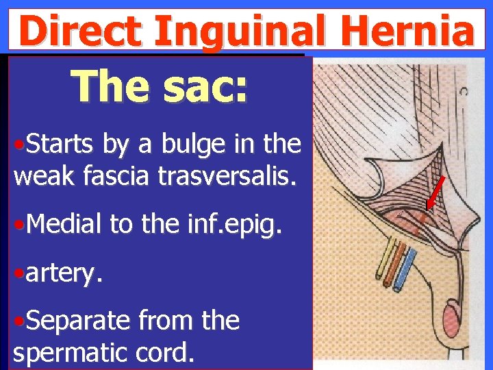 Direct Inguinal Hernia The sac: • Starts by a bulge in the weak fascia