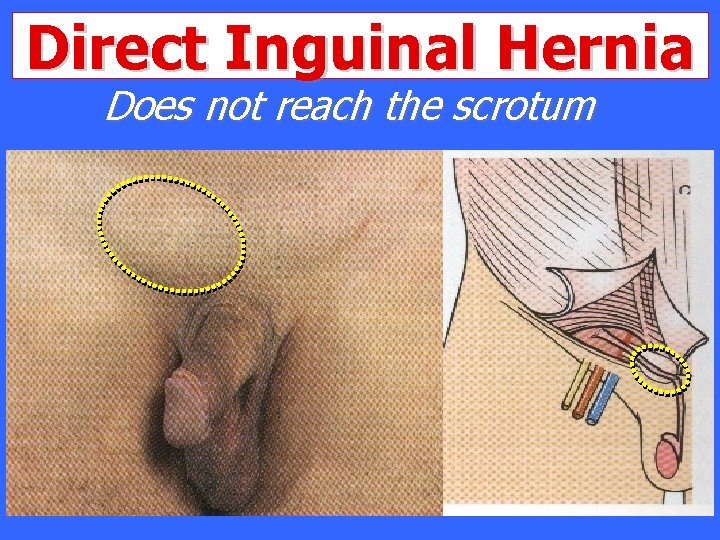 Direct Inguinal Hernia Does not reach the scrotum 