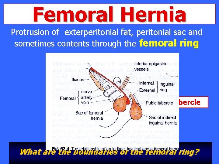 Femoral Hernia Protrusion of exterperitonial fat, peritonial sac and sometimes contents through the femoral