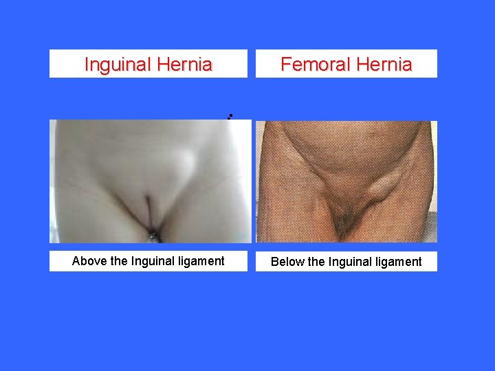 Inguinal Hernia Femoral Hernia Above the Inguinal ligament Below the Inguinal ligament 
