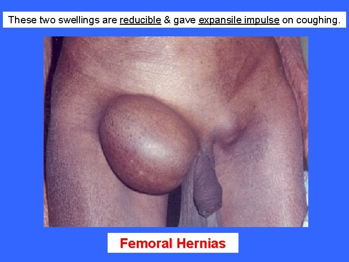 These two swellings are reducible & gave expansile impulse on coughing. Femoral Hernias 