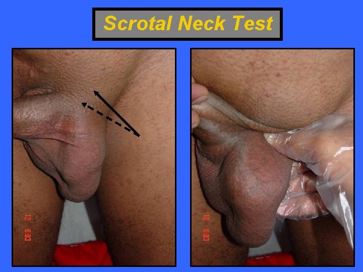 Scrotal Neck Test 