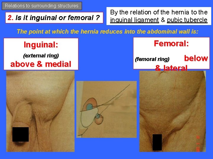 Relations to surrounding structures 2. Is it inguinal or femoral ? By the relation