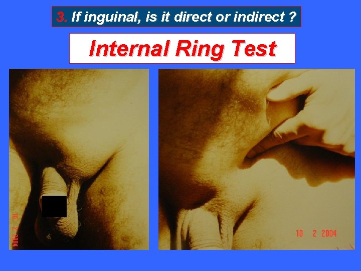 3. If inguinal, is it direct or indirect ? Internal Ring Test X X