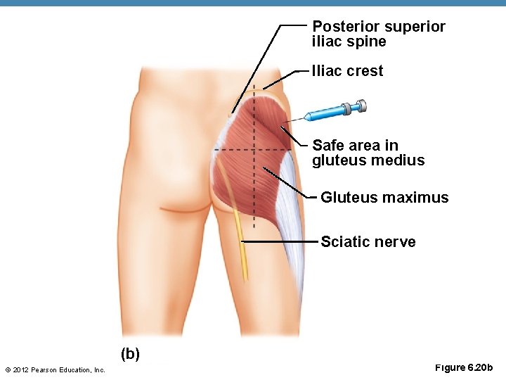 Posterior superior iliac spine IIiac crest Safe area in gluteus medius Gluteus maximus Sciatic Posterior superior iliac spine IIiac crest Safe area in gluteus medius Gluteus maximus Sciatic