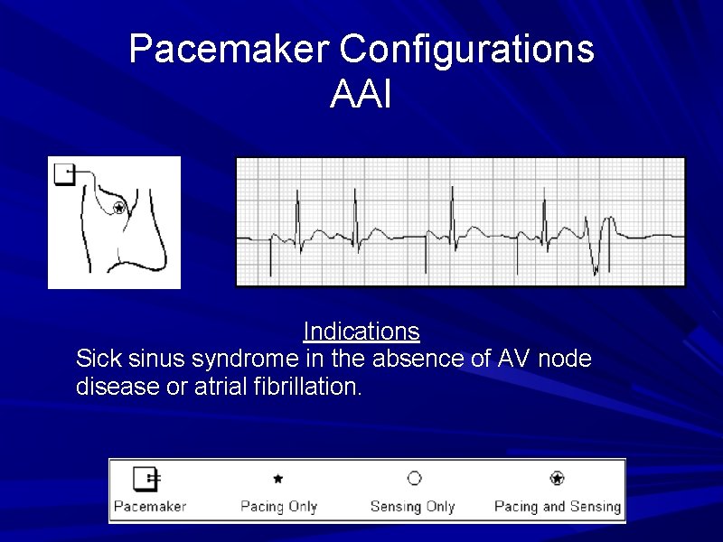 Pacemaker Configurations AAI Indications Sick sinus syndrome in the absence of AV node disease Pacemaker Configurations AAI Indications Sick sinus syndrome in the absence of AV node disease