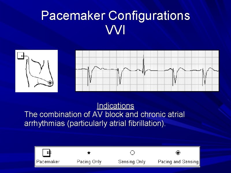 Pacemaker Configurations VVI Indications The combination of AV block and chronic atrial arrhythmias (particularly