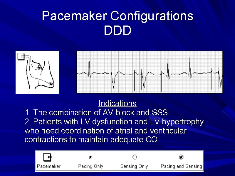 Pacemaker Configurations DDD Indications 1. The combination of AV block and SSS. 2. Patients