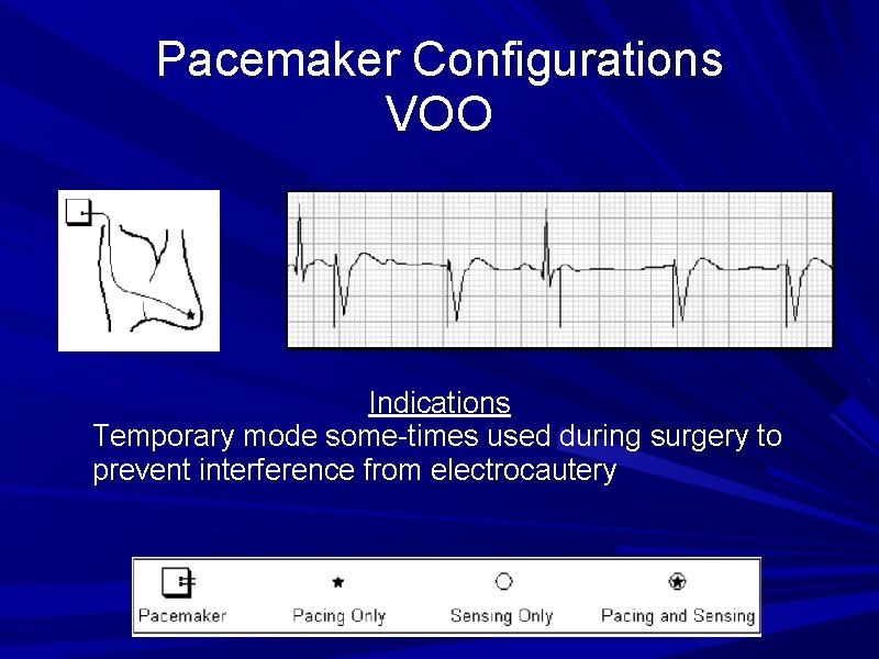 Pacemaker Configurations VOO Indications Temporary mode some-times used during surgery to prevent interference from