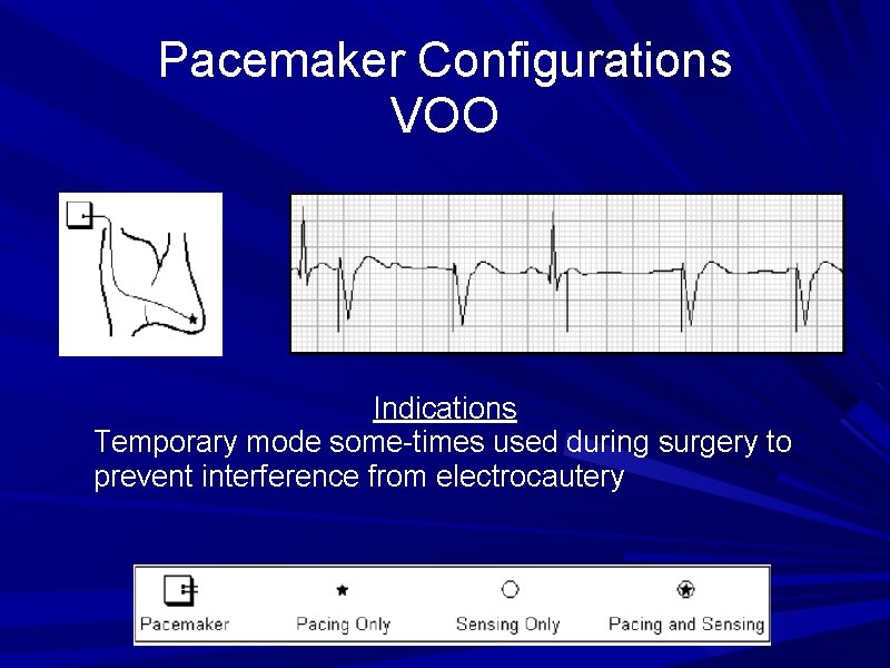 Pacemaker Configurations VOO Indications Temporary mode some-times used during surgery to prevent interference from Pacemaker Configurations VOO Indications Temporary mode some-times used during surgery to prevent interference from