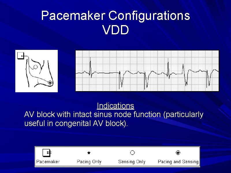 Pacemaker Configurations VDD Indications AV block with intact sinus node function (particularly useful in