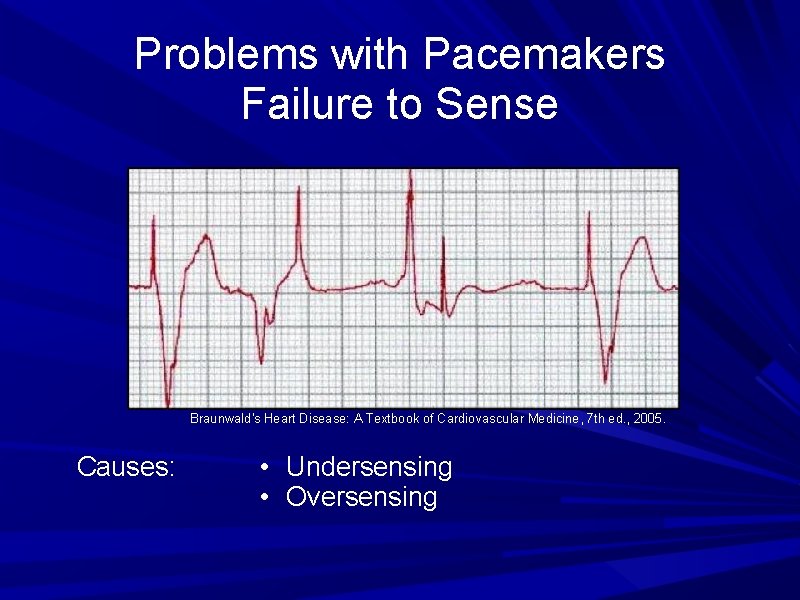 Problems with Pacemakers Failure to Sense Braunwald's Heart Disease: A Textbook of Cardiovascular Medicine,