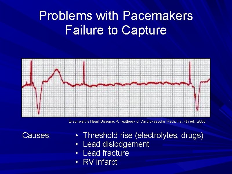 Problems with Pacemakers Failure to Capture Braunwald's Heart Disease: A Textbook of Cardiovascular Medicine, Problems with Pacemakers Failure to Capture Braunwald's Heart Disease: A Textbook of Cardiovascular Medicine,