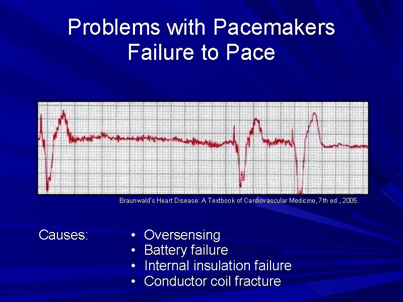 Problems with Pacemakers Failure to Pace Braunwald's Heart Disease: A Textbook of Cardiovascular Medicine,
