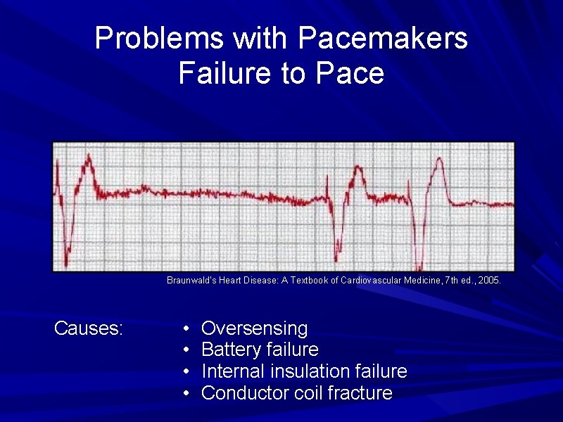 Problems with Pacemakers Failure to Pace Braunwald's Heart Disease: A Textbook of Cardiovascular Medicine, Problems with Pacemakers Failure to Pace Braunwald's Heart Disease: A Textbook of Cardiovascular Medicine,