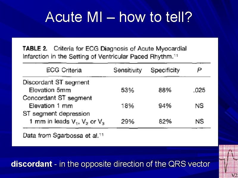 Acute MI – how to tell? discordant - in the opposite direction of the