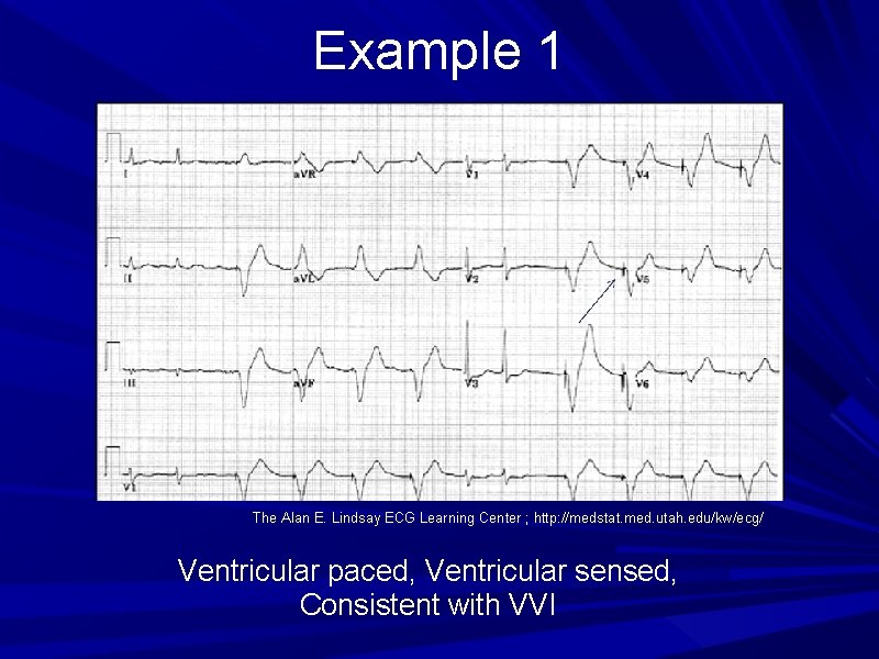 Example 1 The Alan E. Lindsay ECG Learning Center ; http: //medstat. med. utah. Example 1 The Alan E. Lindsay ECG Learning Center ; http: //medstat. med. utah.