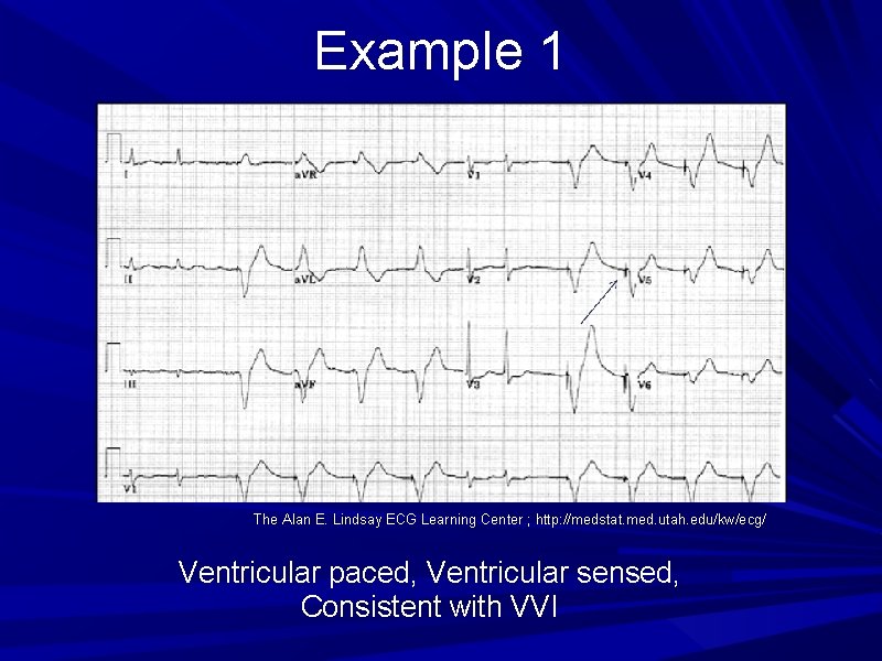 Example 1 The Alan E. Lindsay ECG Learning Center ; http: //medstat. med. utah.