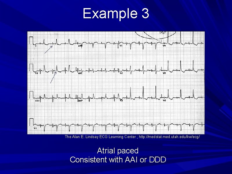 Example 3 The Alan E. Lindsay ECG Learning Center ; http: //medstat. med. utah.