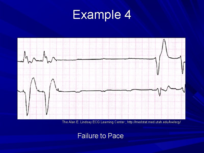 Example 4 The Alan E. Lindsay ECG Learning Center ; http: //medstat. med. utah. Example 4 The Alan E. Lindsay ECG Learning Center ; http: //medstat. med. utah.