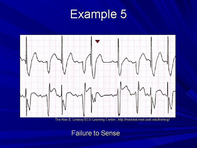 Example 5 The Alan E. Lindsay ECG Learning Center ; http: //medstat. med. utah. Example 5 The Alan E. Lindsay ECG Learning Center ; http: //medstat. med. utah.