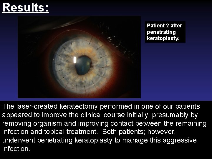 Results: Patient 2 after penetrating keratoplasty. The laser-created keratectomy performed in one of our