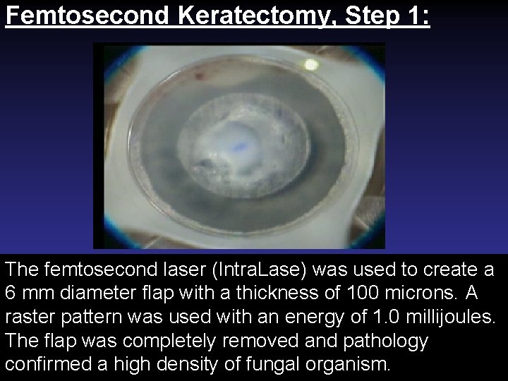 Femtosecond Keratectomy, Step 1: The femtosecond laser (Intra. Lase) was used to create a