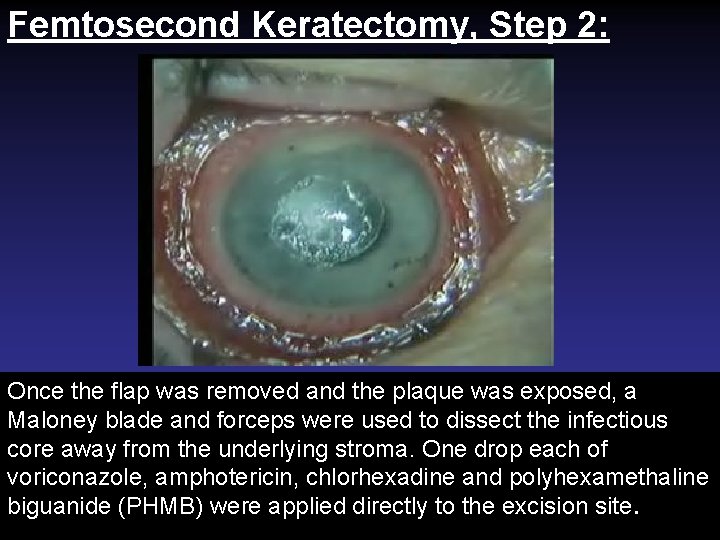Femtosecond Keratectomy, Step 2: Once the flap was removed and the plaque was exposed,