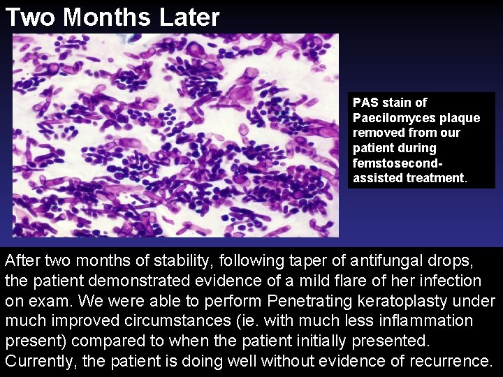 Two Months Later PAS stain of Paecilomyces plaque removed from our patient during femstosecondassisted