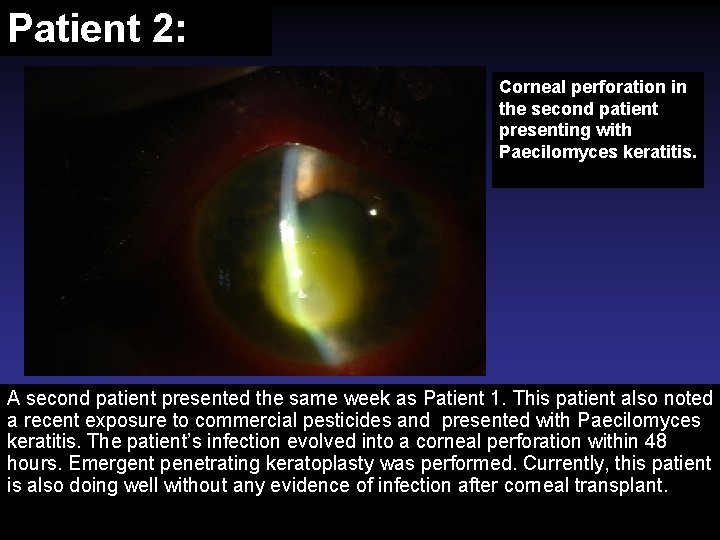 Patient 2: Corneal perforation in the second patient presenting with Paecilomyces keratitis. A second