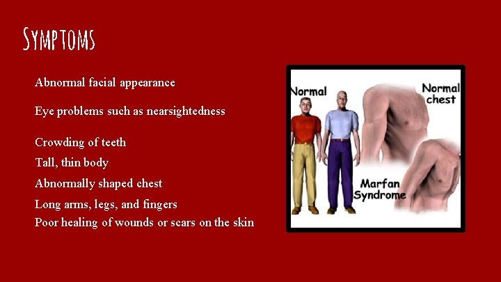Symptoms Abnormal facial appearance Eye problems such as nearsightedness Crowding of teeth Tall, thin