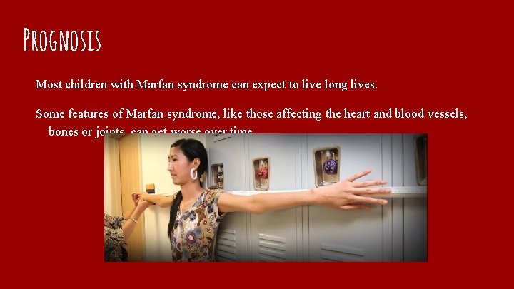 Prognosis Most children with Marfan syndrome can expect to live long lives. Some features